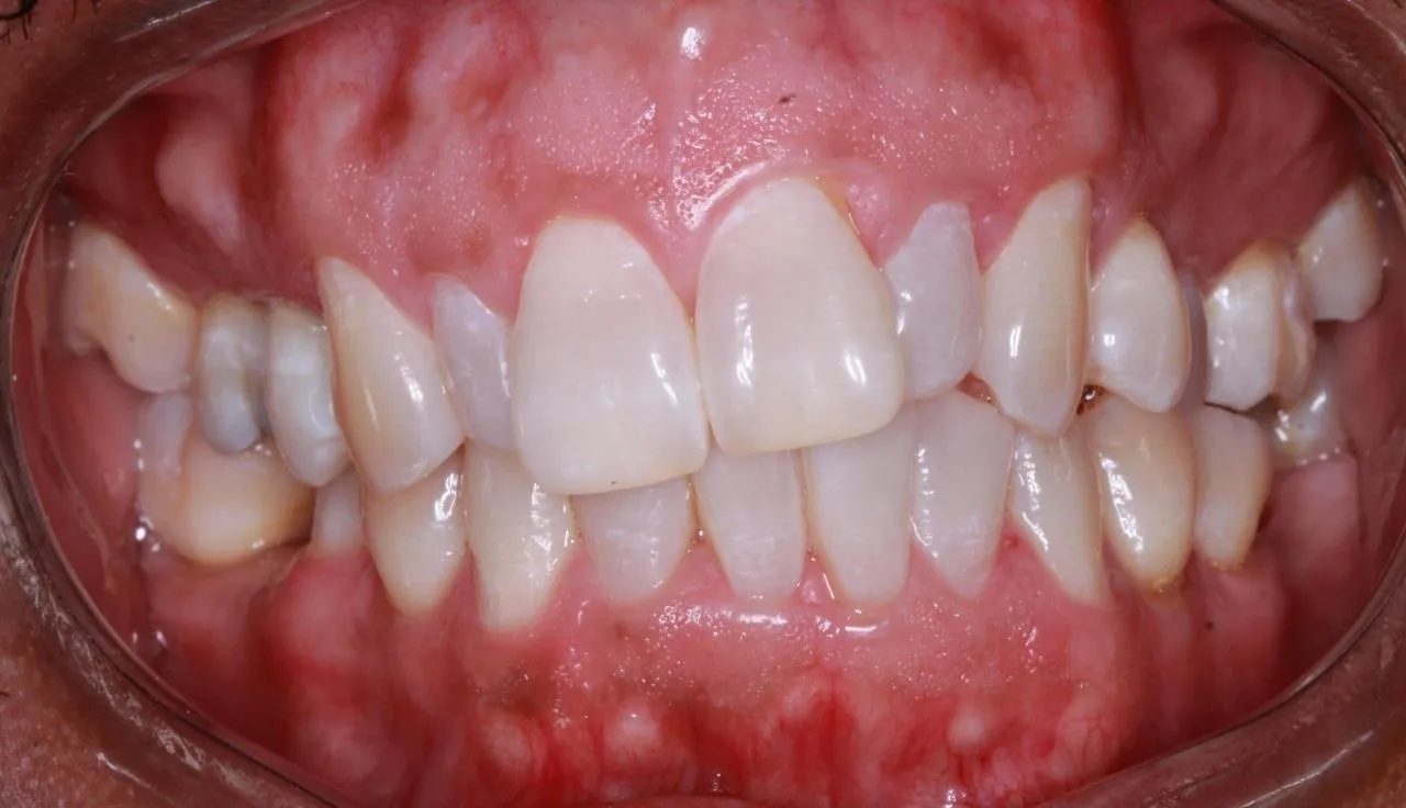 Antes del tratamiento: apiñamiento en el sector anterior e inflamación gingival