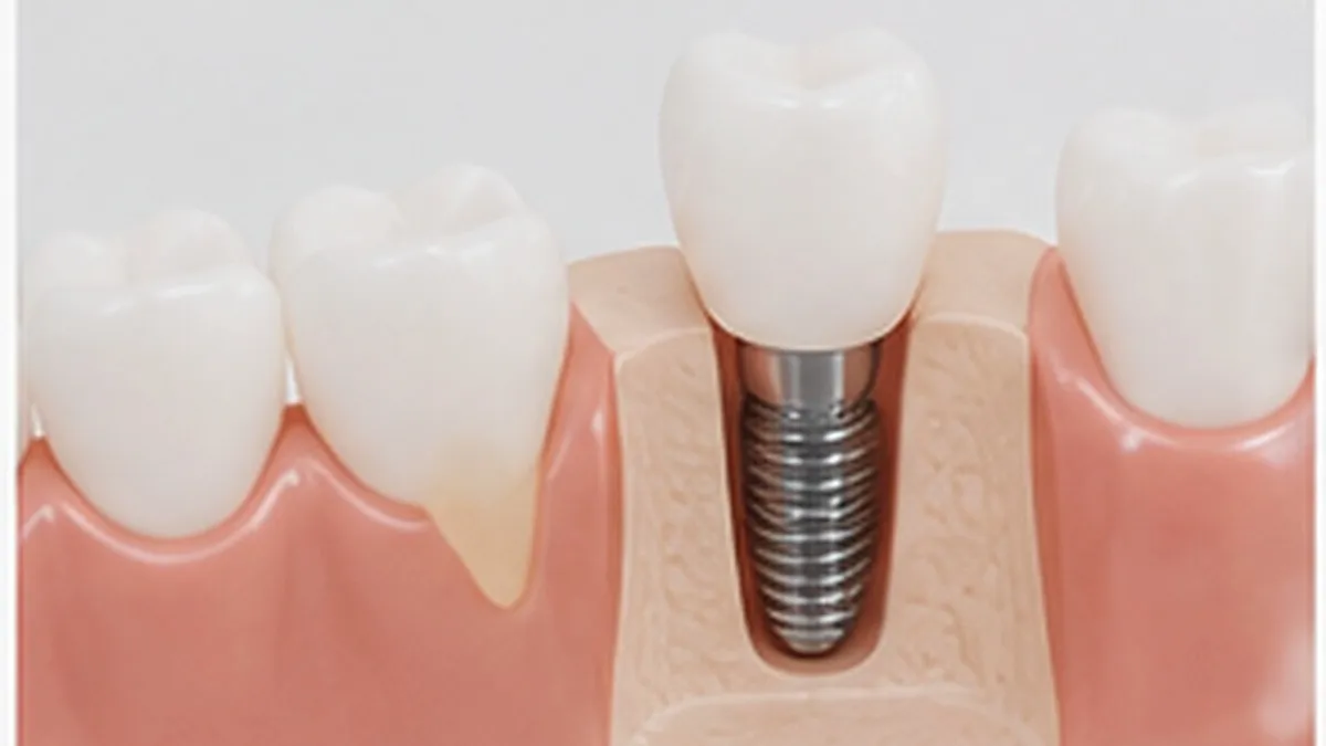 Modelo de implante dental